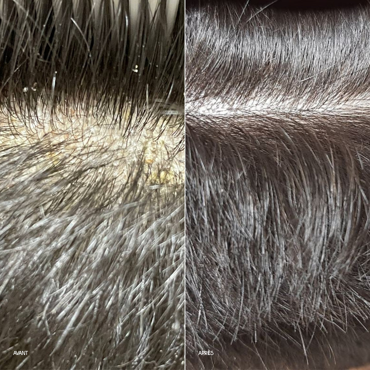 ANTI-DANDRUFF PREBIOTIC PRE-WASH