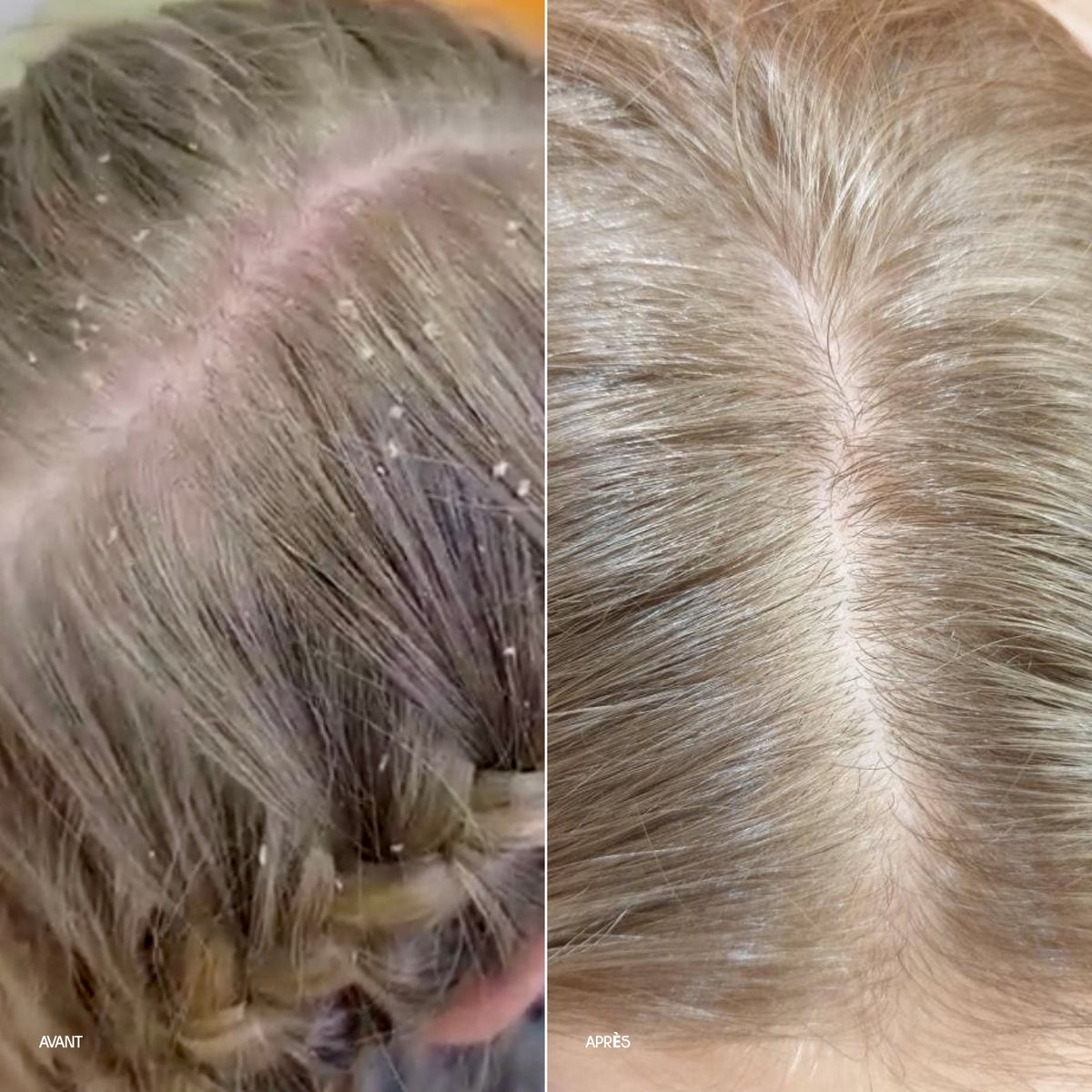 Before and after comparison of hair treatment on a person's head.