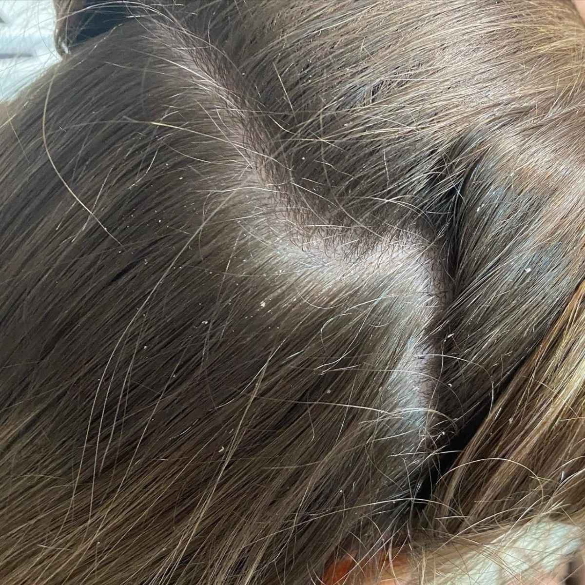 Close-up of brown hair with visible dandruff flakes and dry scalp on the scalp.