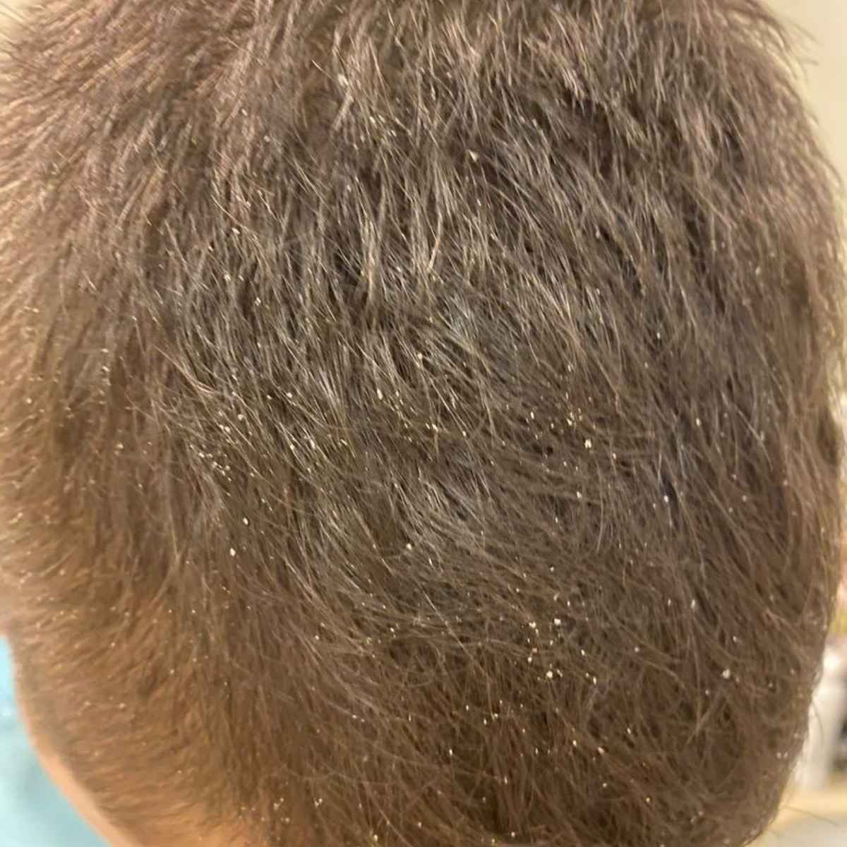 Close-up of a person's dark brown hair with visible dandruff flakes and dry scalp.