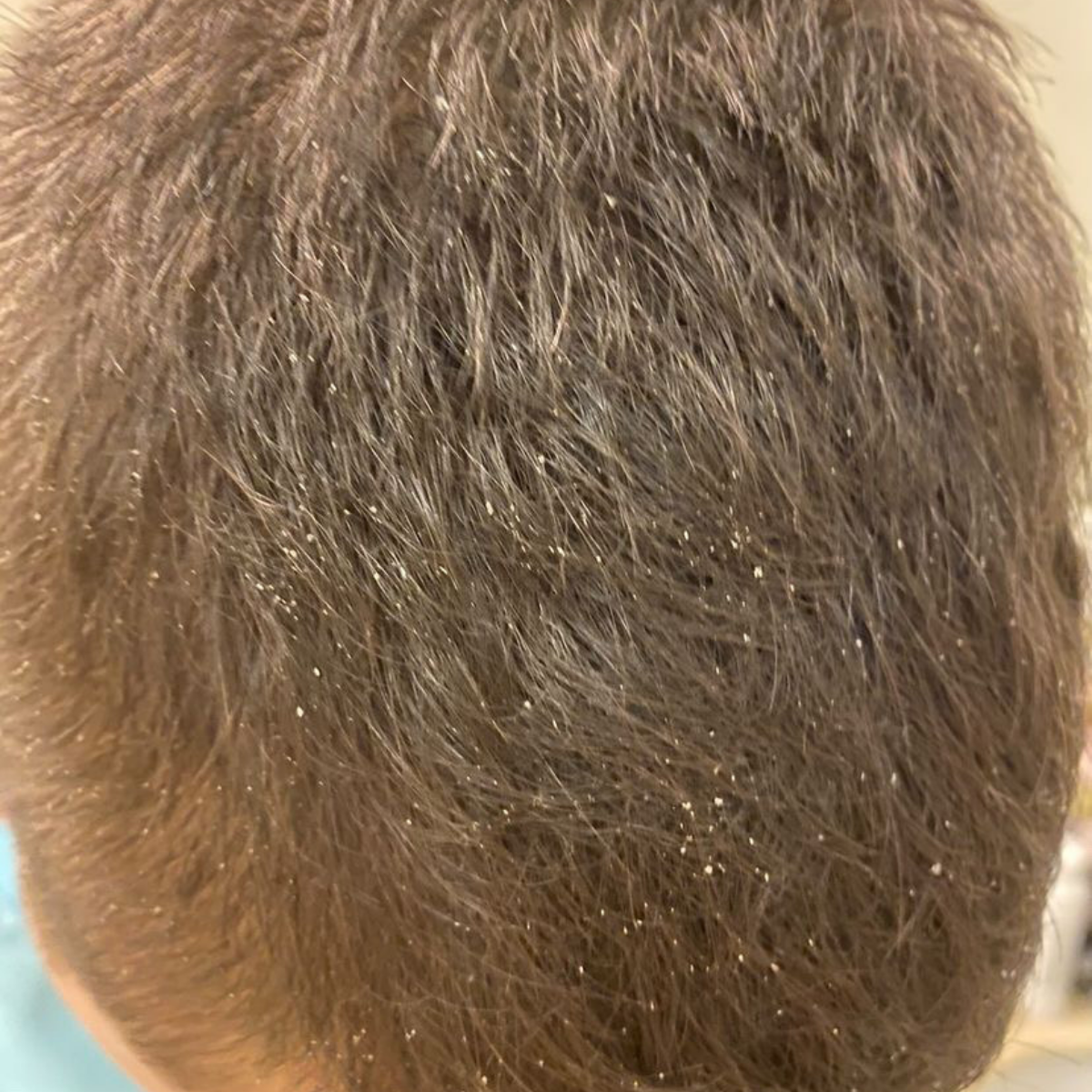 Close-up of the back of a person's head showing brown hair with visible dandruff flakes and dry scalp.