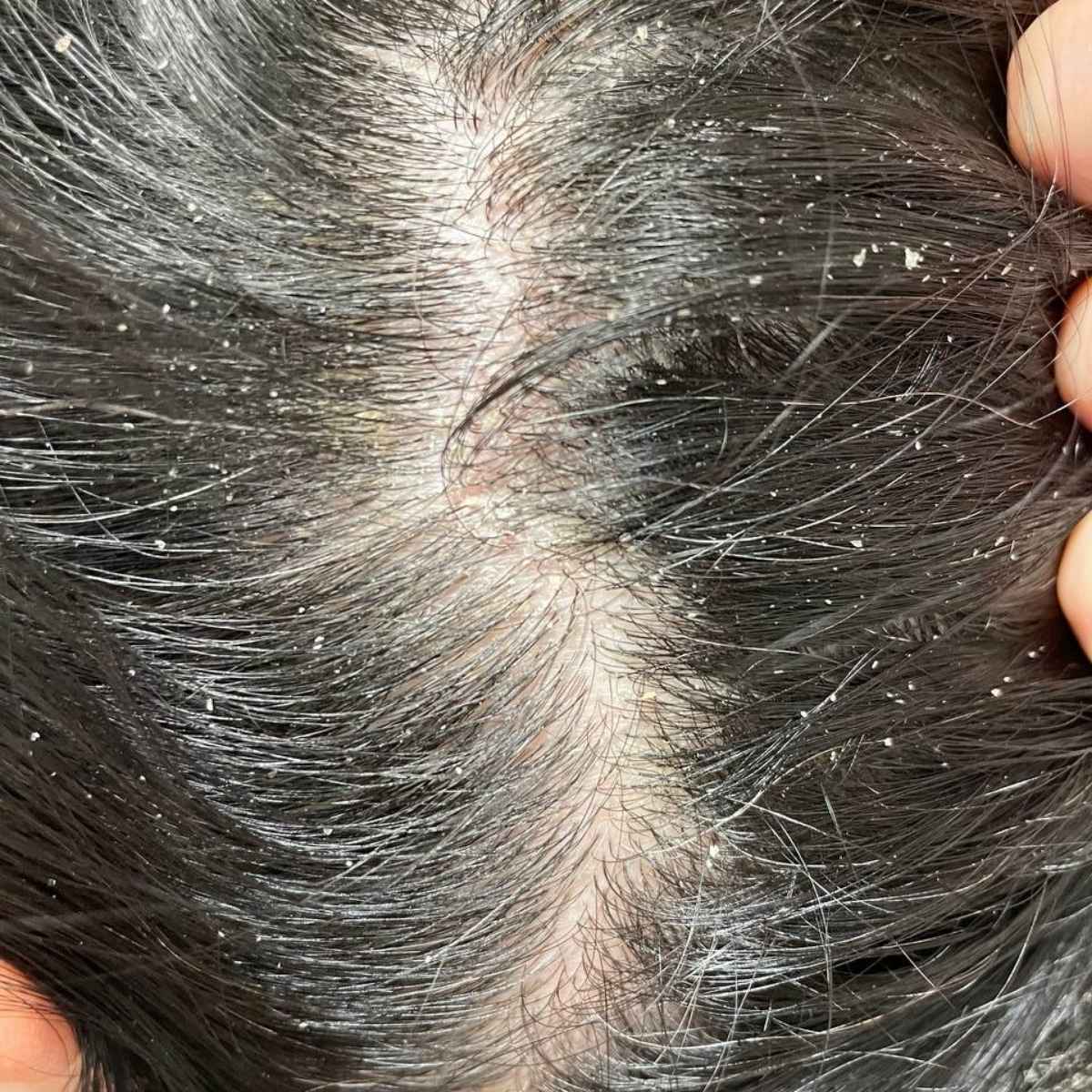 Close-up of the top of a person's head showing dark hair, scalp, and small white flakes on the hair and scalp.